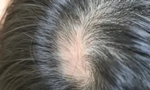 Trẻ rụng tóc sớm có bị hói khi trưởng thành? Trẻ rụng tóc sớm có bị hói khi trưởng thành?