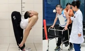 Chàng trai cột sống cong hình chữ Z tập đi sau 20 năm Chàng trai cột sống cong hình chữ Z tập đi sau 20 năm